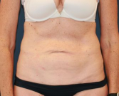 Feel Beautiful - Type 2 Tummy Tuck - Before Photo